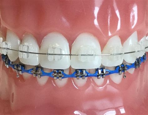 ceramic brackets vs metal|problems with ceramic braces.